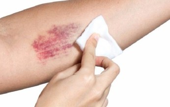 Điều trị chứng xuất huyết giảm tiểu cầu
