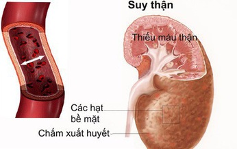 Ph&#242;ng ngừa v&#224; điều trị bệnh lao thận hiệu quả