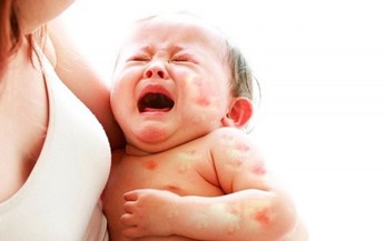Nhận biết dị ứng sữa