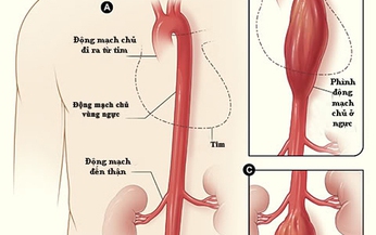 Nguy&#234;n nh&#226;n ph&#236;nh b&#243;c t&#225;ch động mạch chủ