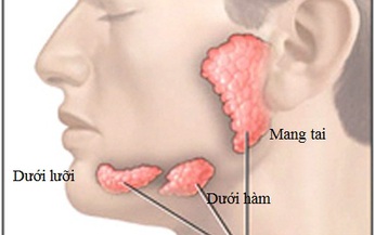 V&#244;i h&#243;a tuyến nước bọt - Nguy hiểm nhưng dễ bị bỏ qua