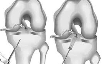 Phẫu thuật nội soi t&#225;i tạo 2 d&#226;y chằng ch&#233;o trước v&#224; sau