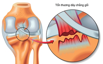 Đứt d&#226;y chằng ch&#233;o trước gối: Khi n&#224;o cần phẫu thuật?