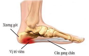 Xử tr&#237; vi&#234;m c&#226;n gan ch&#226;n kh&#244;ng phẫu thuật