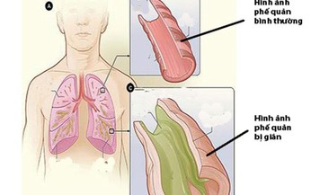 Gi&#227;n phế quản: C&#225;ch ph&#242;ng ngừa v&#224; chăm s&#243;c