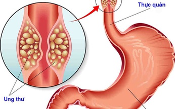 Thực quản tổn thương c&#243; thể g&#226;y ung thư?