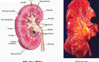 Vi&#234;m cầu thận cấp:  Ph&#225;t hiện sớm, điều trị nhanh