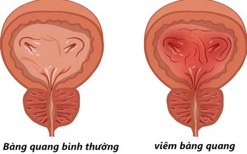 Vi&#234;m b&#224;ng quang t&#225;i ph&#225;t c&#243; nguy cơ g&#236;?