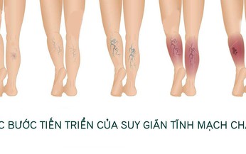 B&#224;i tập cho người suy gi&#227;n tĩnh mạch ch&#226;n