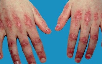 Nhận diện các tổn thương viêm da cơ và viêm đa cơ 