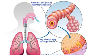 C&#244;ng ph&#225;p trị liệu vi&#234;m phế quản mạn t&#237;nh &#160;