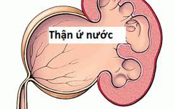 Thận ứ nước k&#233;o d&#224;i dễ tổn thương vĩnh viễn