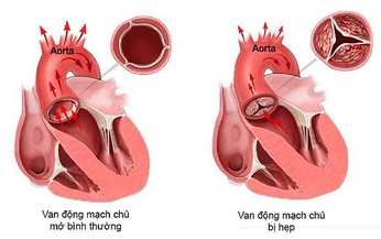 C&#225;ch nhận biết động mạch chủ bất thường