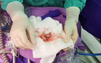 Đau bụng kèm sốt, bé gái 3 tuổi mắc u tuyến thượng thận hiếm gặp