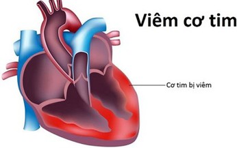 Bộ Y tế: Chưa ghi nhận chủng vi r&#250;t &quot;mới lạ&quot; g&#226;y vi&#234;m cơ tim