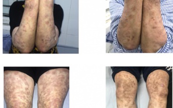 H&#224; Nội: Người phụ nữ mắc phong thể nhiều vi khuẩn giống Lupus ban đỏ