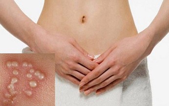 C&#225;ch n&#224;o ph&#242;ng ngừa Herpes sinh dục t&#225;i ph&#225;t?