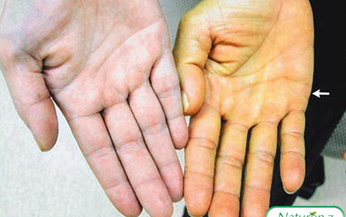 Bệnh viêm gan A là gì?