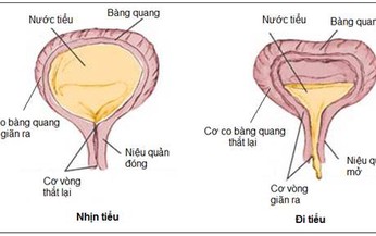 Trị dứt điểm bệnh đ&#225;i dầm v&#224; đ&#225;i kh&#244;ng tự chủ từ thi&#234;n nhi&#234;n