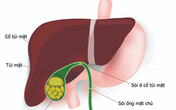 Bị sỏi t&#250;i mật c&#243; nhất thiết phải mổ?