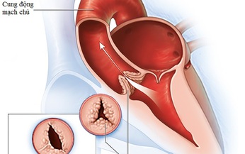 Hở van động mạch chủ, những th&#244;ng tin quan trọng cần nắm r&#245;