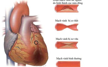 3 nguy&#234;n nh&#226;n g&#226;y thiếu m&#225;u cơ tim kh&#244;ng phải ai cũng biết