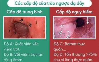 Lời khuy&#234;n cho người bệnh tr&#224;o ngược dạ d&#224;y thực quản