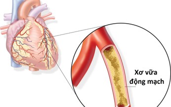 Những th&#244;ng tin kh&#244;ng thể bỏ qua cho người thiếu m&#225;u cơ tim