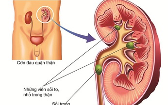 Vi&#234;m bể thận thường do nhiễm tr&#249;ng