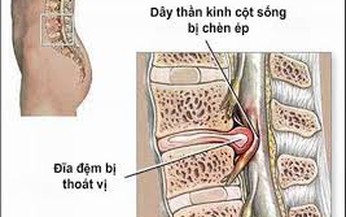 Tho&#225;t vị đĩa đệm cột sống thắt lưng: Cần chữa trị kịp thời trước khi bệnh g&#226;y t&#224;n phế