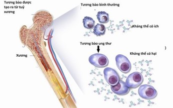 FDA chấp thuận điều trị mới cho đa u tủy