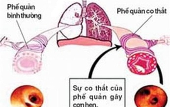 Ph&#234; duyệt thuốc gốc albuterol h&#237;t đầu ti&#234;n trị v&#224; ngăn ngừa co thắt phế quản