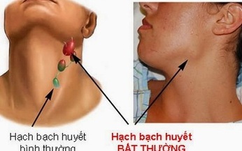 Thuốc mới trị u lympho dòng tế bào B lớn lan tỏa