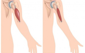 Thuốc mới trị bệnh loạn dưỡng cơ Duchenne do đột biến gen