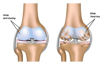 Canakinumab c&#243; thể l&#224;m chậm qu&#225; tr&#236;nh tho&#225;i h&#243;a khớp?