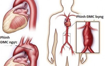 Fluoroquinolones c&#243; li&#234;n quan đến tăng nguy cơ ph&#236;nh động mạch chủ