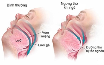 Điều trị ngưng thở khi ngủ, gi&#250;p giảm nguy cơ mắc Alzheimer