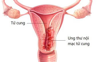 Bất lợi qua trung gian miễn dịch của thuốc trị ung thư nội mạc tử cung