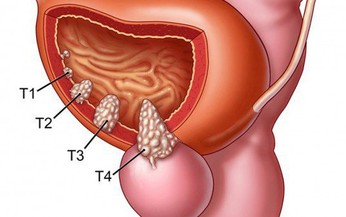 Liệu ph&#225;p mới điều trị ung thư b&#224;ng quang