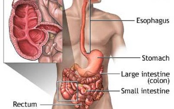 Ph&#225;t hiện mới về ảnh hưởng của bệnh Crohn l&#234;n n&#227;o