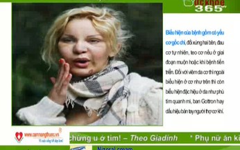 Bệnh viêm đa cơ: Điều trị sớm, phục hồi cao