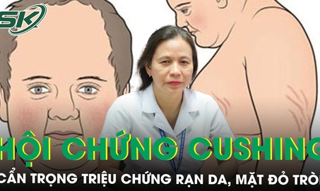 Rạn da, mặt đỏ tr&#242;n cẩn trọng với hội chứng Cushing 