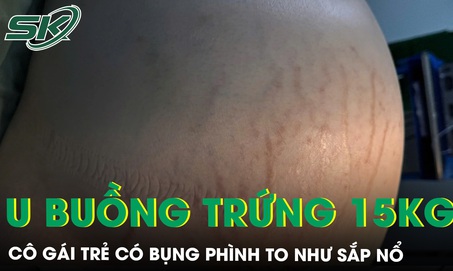 Bụng phình to như sắp nổ cô gái trẻ mang u buồng trứng khổng lồ 15kg