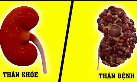 4 thói quen gây hỏng thận nhanh nhất cần thay đổi ngay