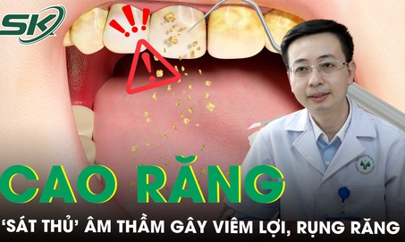 Cao răng - ‘Sát thủ' âm thầm gây viêm lợi, rụng răng mà bạn không ngờ tới