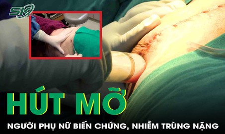 Người phụ nữ nhận 'kết đắng' sau khi hút mỡ làm đẹp