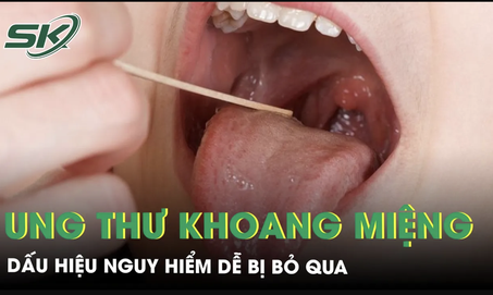 Ung thư khoang miệng: Dấu hiệu nguy hiểm dễ bị bỏ qua