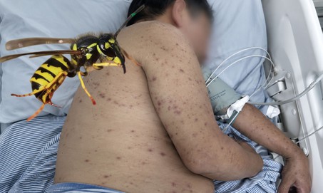 Người đàn ông 62 tuổi suýt chết vì bị ong đốt 300 nốt