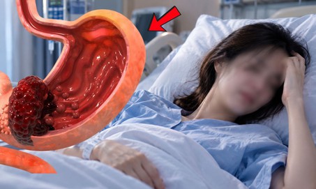 Người phụ nữ phát hiện ung thư dạ dày giai đoạn cuối từ dấu hiệu ợ