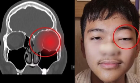 Không triệu chứng mũi xoang, bé trai phát hiện khối u 5 cm đẩy lồi nhãn cầu